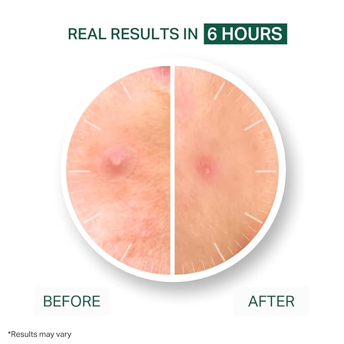 YβOUR Essential Acne Treatment Duo: Spot Treatment & Healing Patches; Pimple Clearing, Pore Minimizing Skincare. Made in USA. Basic Routine for All Skin Types