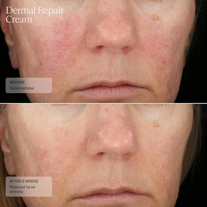 SentΓ© Dermal Repair Facial Cream | Nourishing for Rosacea & Sensitive Skin | Hydrate & Rejuvenate | with Patented HSA, Vitamin E & Green Tea Extract - 1.7 Fl Oz