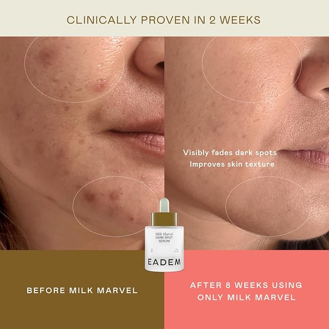 EADEM Milk Marvel Dark Spot Serum, Vitamin C Face Serum Infused with Niacinamide, Dark Spot Remover for Face & Body, Dark Spot Corrector for Skin Care, 1 oz