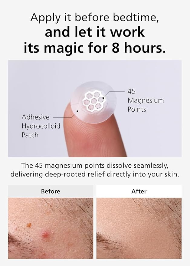 EasyDerm Magnesium Pimple Patches β Hydrocolloid Acne Spot Treatment with Ampoule & Tweezer, 10 Calming Zit Stickers by Daewoong, μ΄μ§λ€, λμ
μ μ½