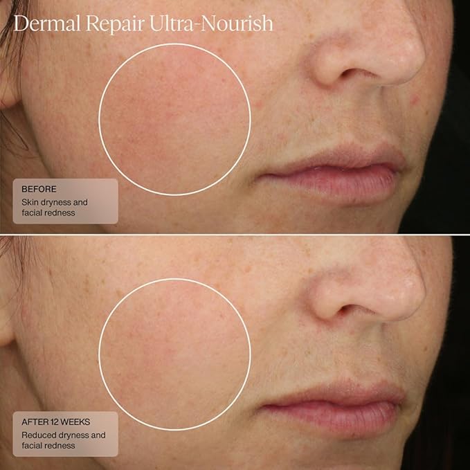 SentΓ© Dermal Repair Ultra-Nourish - Rosacea Treatment For Dry, Sensitive Skin | Repairs, Replenishes & Reduces Skin Redness - 1.7 Fl Oz