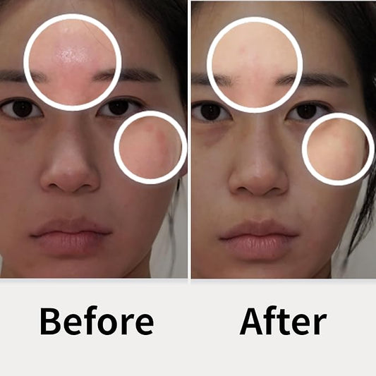 Ato Fast Calming Patch for Skin Redness, Itching & Flare-Ups β Soothing Hydrogel for Sensitive Skin with Cica & Panthenol β 10 Pairs