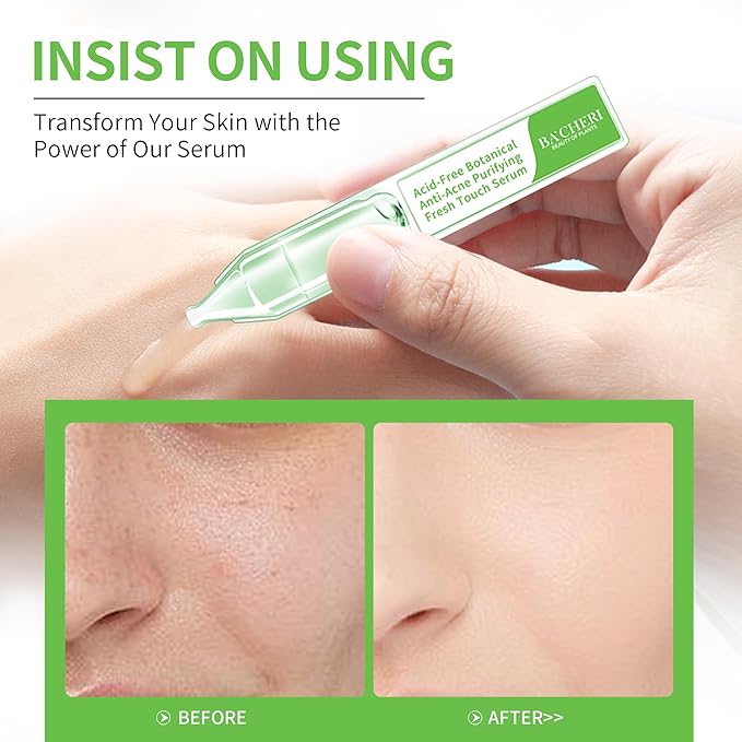 Gentle Botanical Acne Treatment for Face β Acid-Free Spot Facial Serum with Niacinamide & Witch Hazel, Soothes Redness & Controls Breakouts for Sensitive, Oily & Acne-Prone Skin β 1.2 ml Γ 30 Ampoules