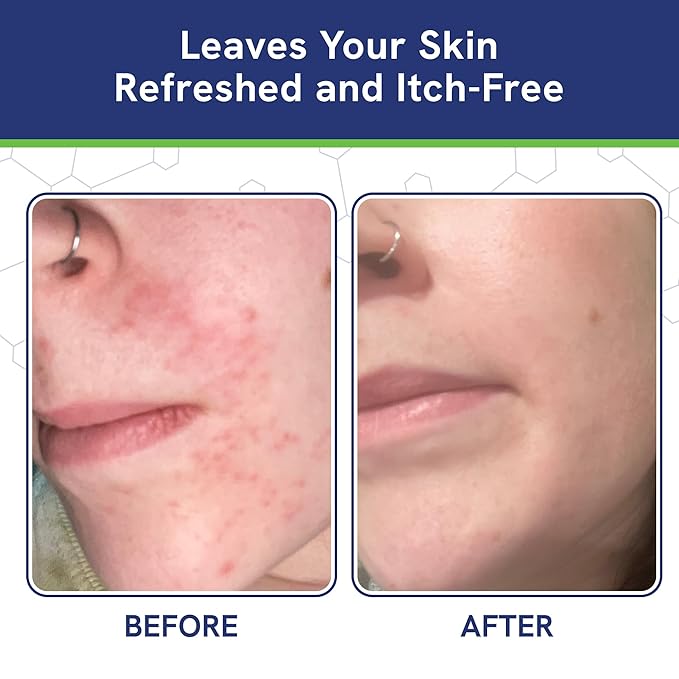 pHat 5.5 Seborrheic dermatitis Moisturizing Cream & Face Lotion for Women - Soothing Redness for Face & Body Cream - Hydrating for Dry Skin & Anti Itch Lotion (8oz)