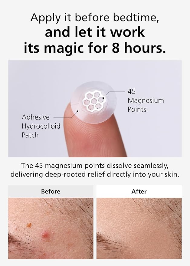 EasyDerm Quick Calming Magnesium Patches β Hydrocolloid Acne Spot Treatment Includes Tweezers & Ampoule, 10 Patches, Zit Sticker, TikTok Viral Blemish Patch, Made by Daewoong Pharmaceutical