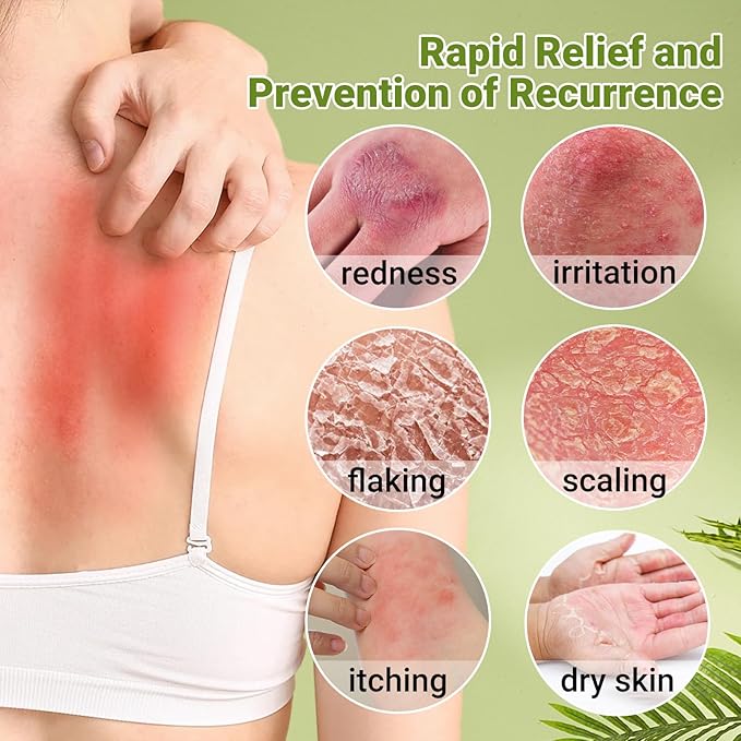 Psoriasis Cream, Maximum Strength Treatment Moisturizing Cream for Psoriasis, Dermatitis, Rash, Anti-Itch, Redness, Flaking, Scaling, Fast Acting Relief for Irritated, Dry Skin