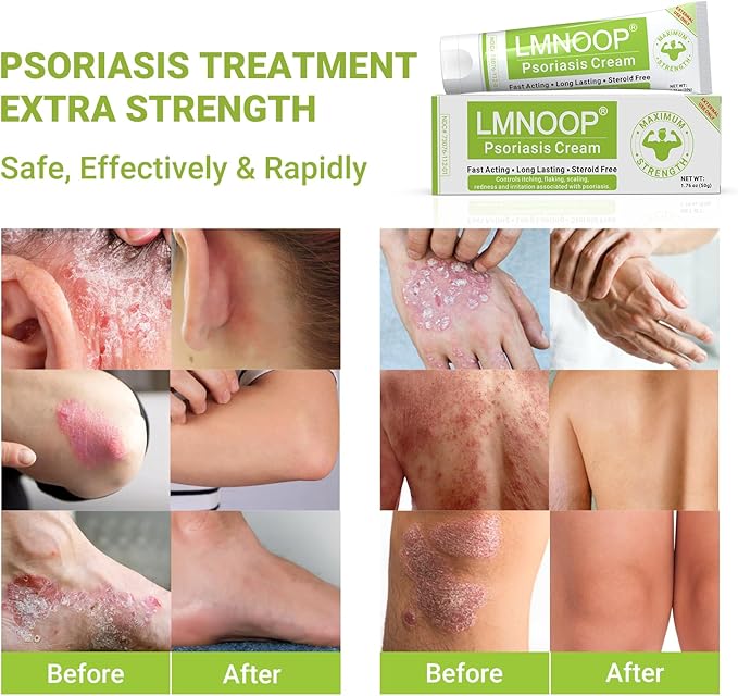 Psoriasis Cream, Maximum Strength Treatment Moisturizing Cream for Psoriasis, Dermatitis, Rash, Anti-Itch, Redness, Flaking, Scaling, Fast Acting Relief for Irritated, Dry Skin