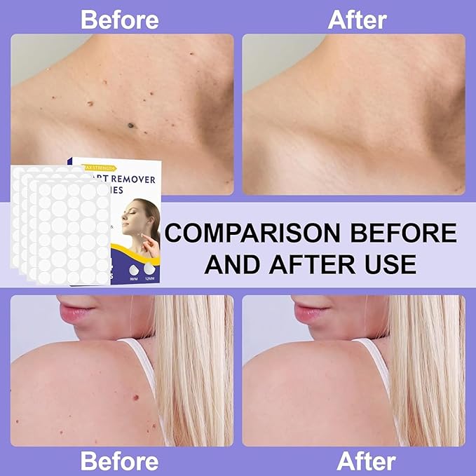 Wart Remover Patches, Skin Care Removal Patches with Maximum Strength, Fast & Easy Operate Hydrocolloid Waterproof Invisible Sticker for All Skin Types-144pcs(PP-02CH)