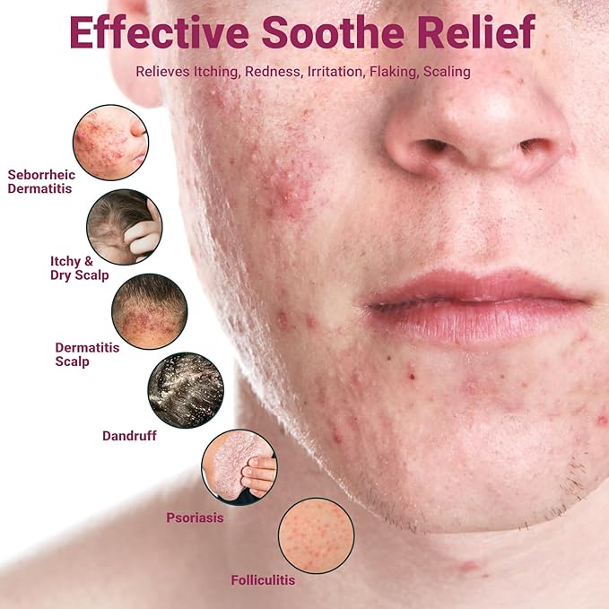 Seborrheic Dermatitis Cream, Maximum Strength Treatment for Psoriasis, Folliculitis, Dermatitis, Dandruff, Fast Relief for Itching, Redness, Irritation, Scaling, 3.53 Oz