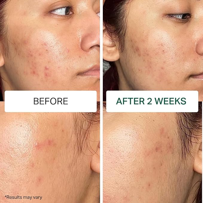 Y'OUR Acne Skincare Kit for Adults β 5-Step System with Cleanser, Day Cream, Serum, Night Cream & Mask β Fights Breakouts & Blemishes β Hydrating & Non-Comedogenic Formula