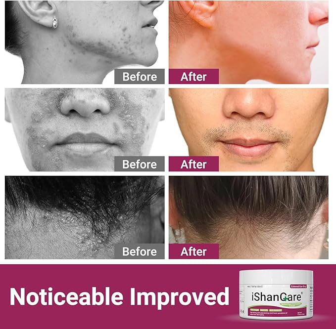 Seborrheic Dermatitis Cream, Maximum Strength Treatment for Psoriasis, Folliculitis, Dermatitis, Dandruff, Fast Relief for Itching, Redness, Irritation, Scaling, 3.53 Oz