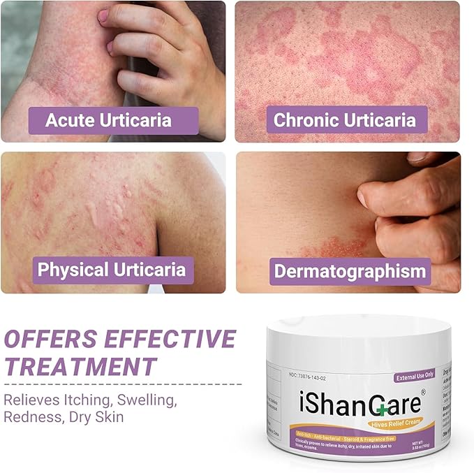 Urticaria Cream, Fast Acting Relief of Hives, Allergic Rashes, Itchy Skin, Redness, Swelling, Anti Fungal Hives Cream with All Natural Herbal Ingredients, 3.53 Oz
