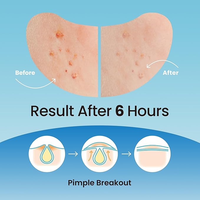 Ultra Invisible Salicylic Acid Acne Patches & Large Pimple Patches for Nose, Forehead, and Chin β Hydrocolloid, Zit, and Spot Treatment for Cystic Acne, Breakout Control, 148 Patches Bundle