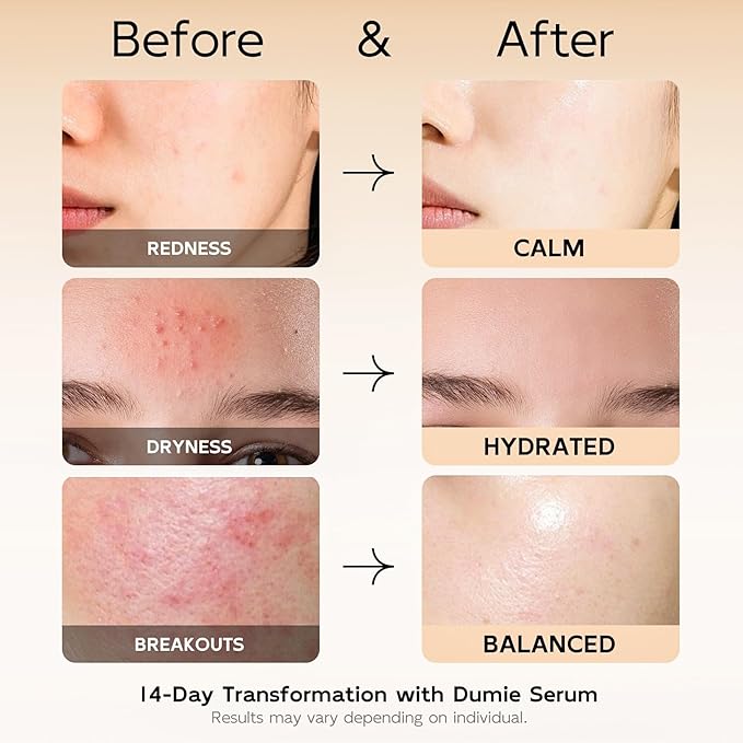 Azelaic Acid Serum 10%, Azelaic Acid For Face With Centella Asiatica Serum For Redness and Uneven Skin Tone, Hyaluronic Acid & Ceramide 3 โ Soothes & Clears Pores For Sensitive Skin, 1.01 fl oz