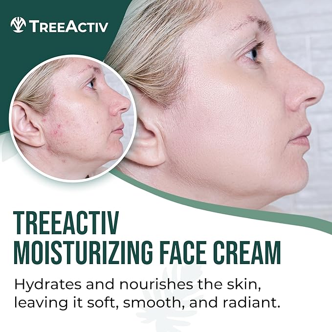 TreeActiv Acne Eliminating Face Cream | Best Natural Extra Strength Fast Acting Treatment for Clearing Facial Acne | Gentle Enough for Sensitive Skin, Adults, Teens, Men, Women | Tea Tree | 2 fl oz