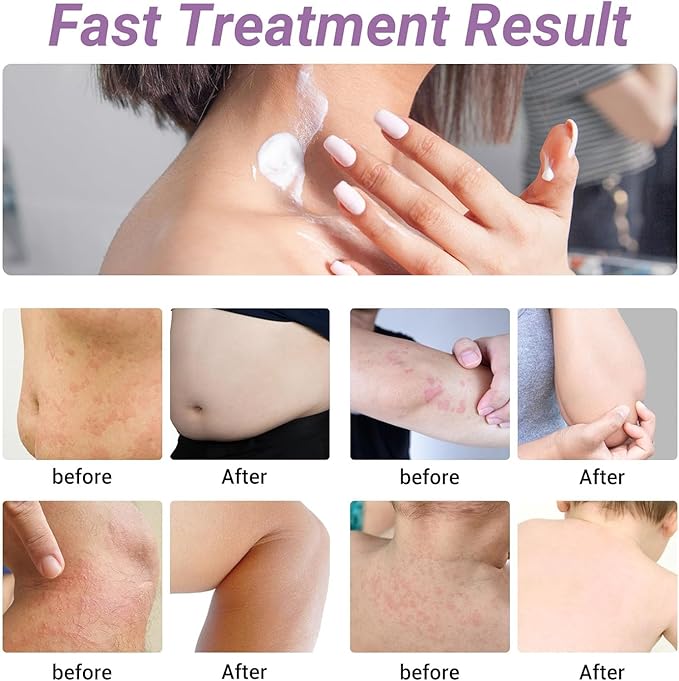 Urticaria Cream, Fast Acting Relief of Hives, Allergic Rashes, Itchy Skin, Redness, Swelling, Anti Fungal Hives Cream with All Natural Herbal Ingredients, 3.53 Oz