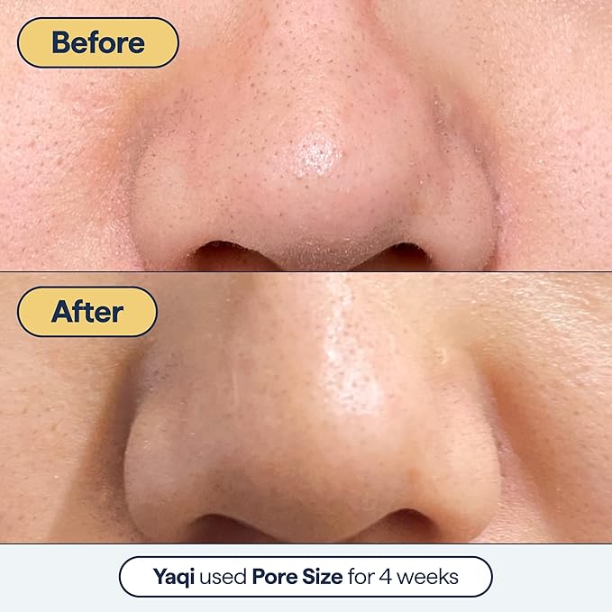 Remedy for Pore Size β Large Pore Minimizer with Retinol, BHA Salicylic Acid, Niacinamide β for Uneven Texture, Pimples, Blackheads, Whiteheads, Sebaceous Filaments β by Dermatologist Dr. Shah