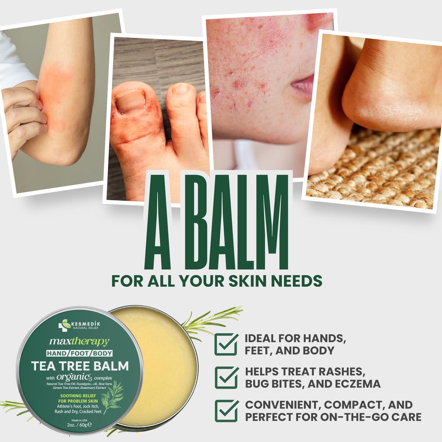 KESMEDIK Tea Tree Oil MaxTherapy Balm, Itchy Skin Relief, Soothing for Rashes, Jock Itch, Athlete’s Foot, Chafing, Insect Bites, Folliculitis, Dry Sensitive Skin, Effective & Safe for All Ages, 1-Pack