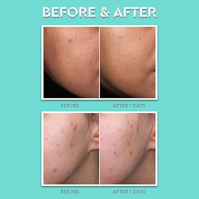 Bliss Clear Genius Acne Spot Treatment β Maximum Strength 2% Salicylic Acid Shrinks Blemishes β Clean, Vegan, Cruelty-Free, 0.5 Fl Oz