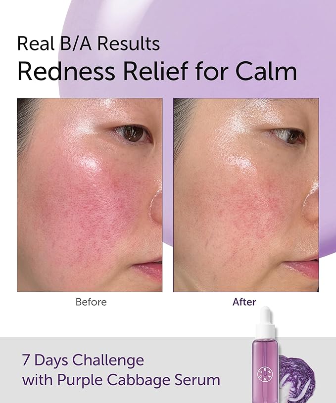 SERUMKIND Purple Cabbage Serum - Calming and Skin Recovery- Korean Face Skincare β Beta Glucan 100,000ppm β Soothing & Redness Relief - Vegan, Cruelty-Free β 1.01 fl.oz.