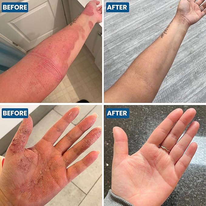 C+ Eczema Cream for Adults - Eczema Lotion for Extremely Dry Skin, Redness, Itch Relief & Dermatitis with Manuka Honey & Calendula | Clinically Proven & Steroid-Free (1 x 4.23oz)