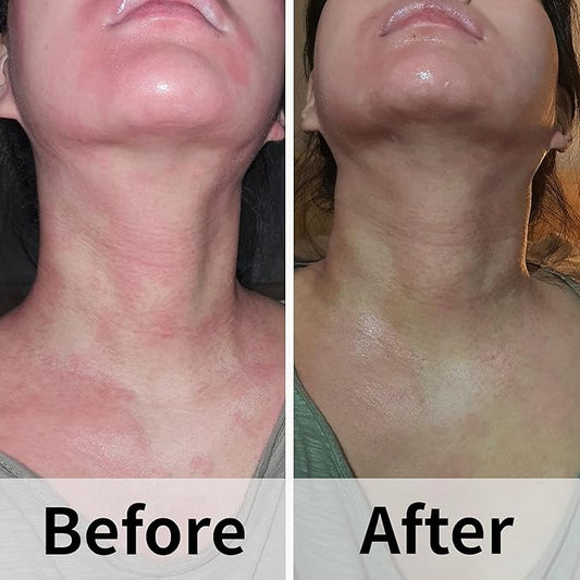 Ato Fast Calming Serum for Sensitive & Eczema-Prone Skin Instant Relief from Itch, Redness & Flare-Ups Powered by Cica & Panthenol 1.69 Fl Oz