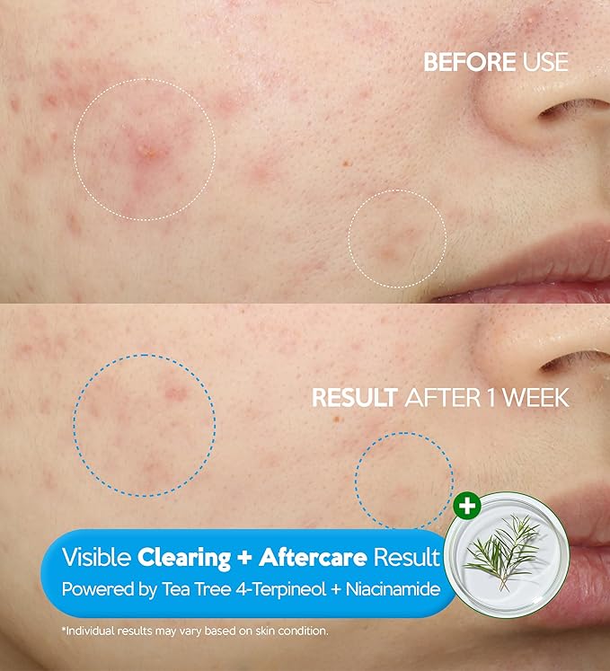 Troubless Clear Barrier Plus Booster Serum - Soothing & Hydrating Serum for Face w/Niacinamide & Tea Tree - Fast-Absorbing, Non-Greasy & Moisturizing (1.01 fl oz)