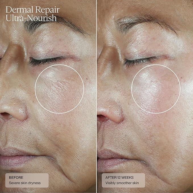 SentΓ© Dermal Repair Ultra-Nourish - Rosacea Treatment For Dry, Sensitive Skin | Repairs, Replenishes & Reduces Skin Redness - 1.7 Fl Oz
