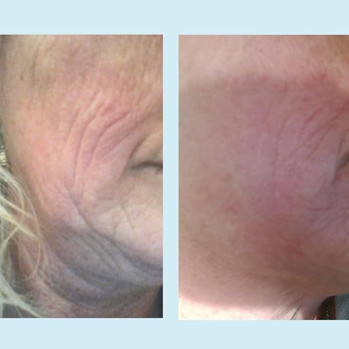 Lactic 50% Gel Peel, Chemical Peels for Face Breakout Scars, Chemical Exfoliant for Face, Strength Level 2, 1.0 fl oz. e, 30 mL – Perfect Image