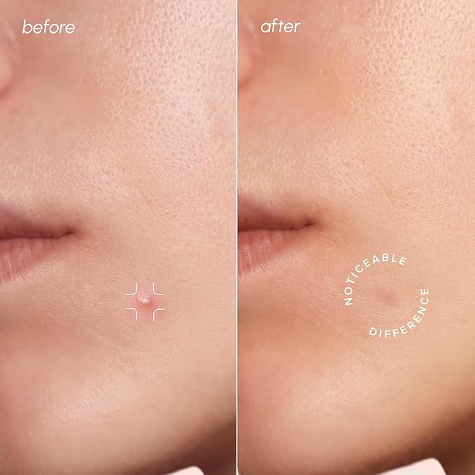 MAREE Pimple Patches for Face - Clear Acne Patches for Face - Invisible Hydrocolloid Patch Parches Para Acne Stickers Zit Dots - Cystic Zit Healing Blemish Pinple Dark Spot Covers