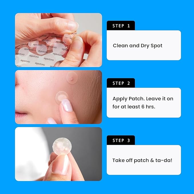 AVARELLE Pimple Patches for Face | Hydrocolloid Acne Patches for Covering Blemishes | FSA HSA Zit Patches with Tea Tree, Calendula, & Cica | HSA Store Eligible Items (10-14 mm, 200, Count)