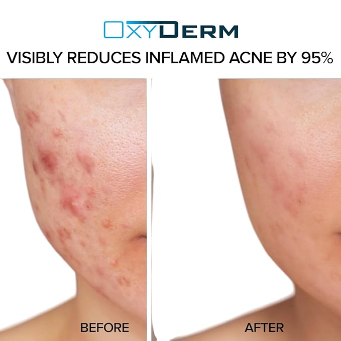 Acne Treatment Pads- Eliminates Cystic Breakouts, Oily Skin & Clogged Pores. Clear Pimple, Whitehead, Blackhead, Dark Spots & Improve Skin Texture.