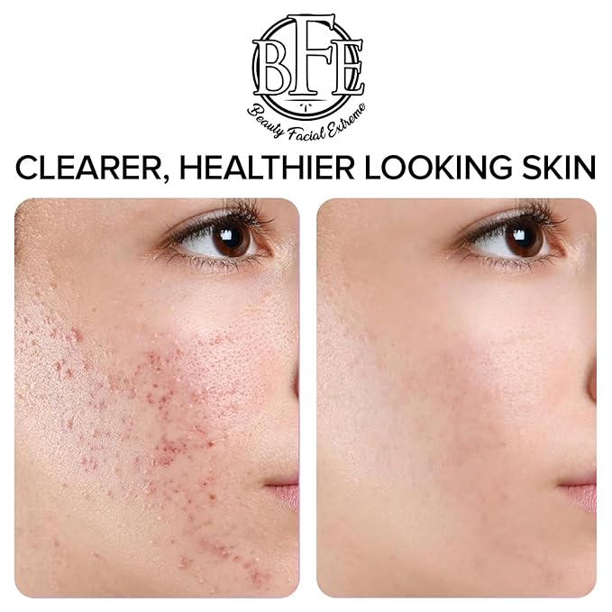 Acne Treatment Pads- Eliminates Cystic Breakouts, Oily Skin & Clogged Pores. Clear Pimple, Whitehead, Blackhead, Dark Spots & Improve Skin Texture.