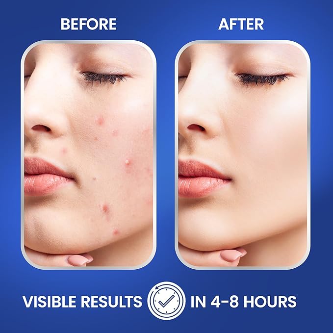 Pimple Patches for Face | Hydrocolloid Acne Patches with Tea Tree Oil & Salicylic Acid | For Zits, Blemishes, Breakouts | Medical-Grade Hydrocolloid | Overnight PM Patches | Pack of 72