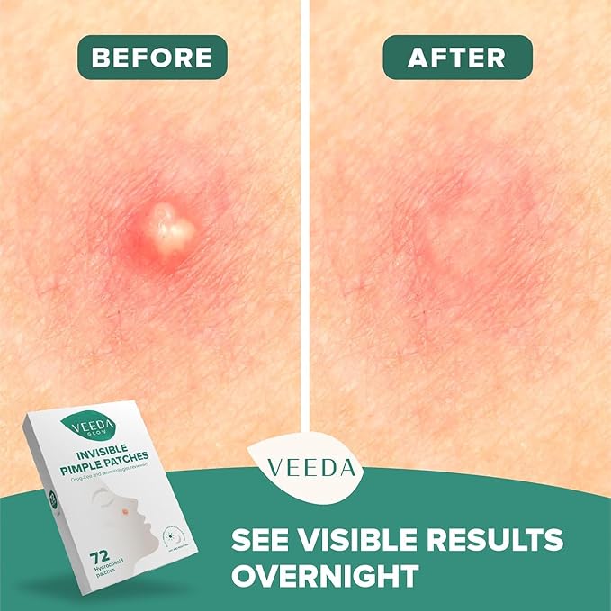 Veeda Glow Pimple Patches – Hydrocolloid Acne Stickers for Fast Healing, Invisible & Non-Irritating Zit Covers, Blemish Spot Treatment, 72 Count