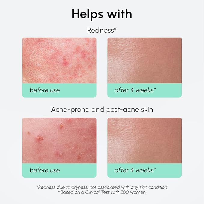 MAREE 10% Azelaic Acid Face Serum - Redness Soothing Hydrating Serum with Niacinamide, Centella Asiatica & Hyaluronic Acid - Relief Serums for Face & Body - Azalecic Acid Skin Facial - Acido Azelaico