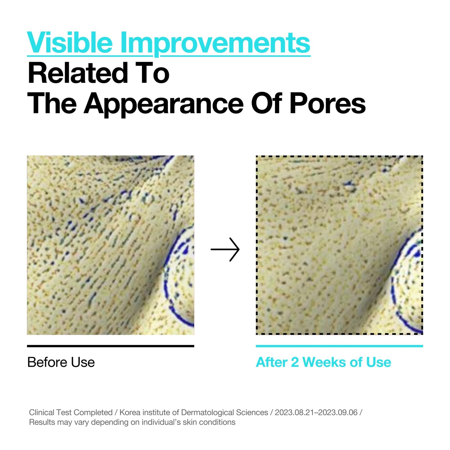 ANUA BHA 2% Gentle Exfoliating Toner, Mild Facial Exfoliant, Salicylic Acid for Pores and Sebum, Teatree Extract, Hyaluronic Acid, Ceramides (150ml / 5.07 fl.oz.)