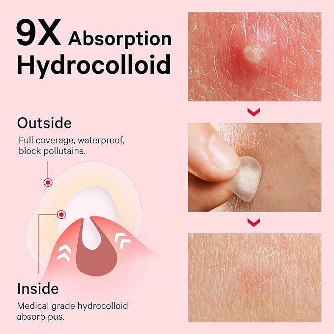 Sosky Pimple Patches for Face, FSA HSA Eligible Invisible Hydrocolloid Acne Patches, Zit Sticker for Face and Skin, Pimple Sticker for Covering Zits, Blemishes with Salicylic Acid 48 Count