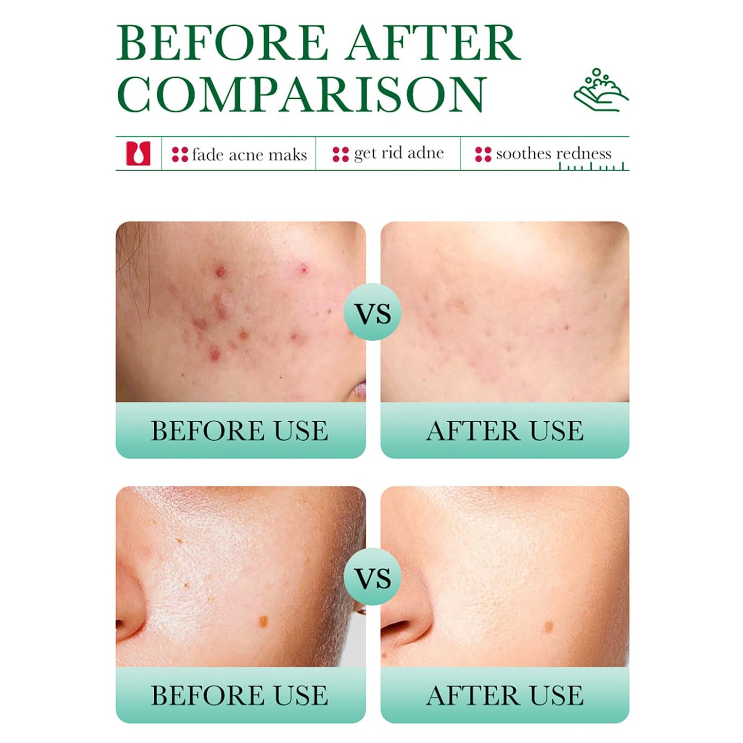 BIOAQUA Salicylic Acid Acne Marks Removal Deep Foam Cleanser Shrink Pores Soothing Oil Control 100g / 3.52fl.oz