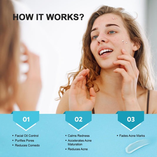 Acne Pimple Spot Treatment Cream: Cystic Hormonal Blackheads Blemish Remover for Face, Back and Body - with 10% Azelaic Acid - Teens 13-19 & Young Adult 20-30, 1.8 oz