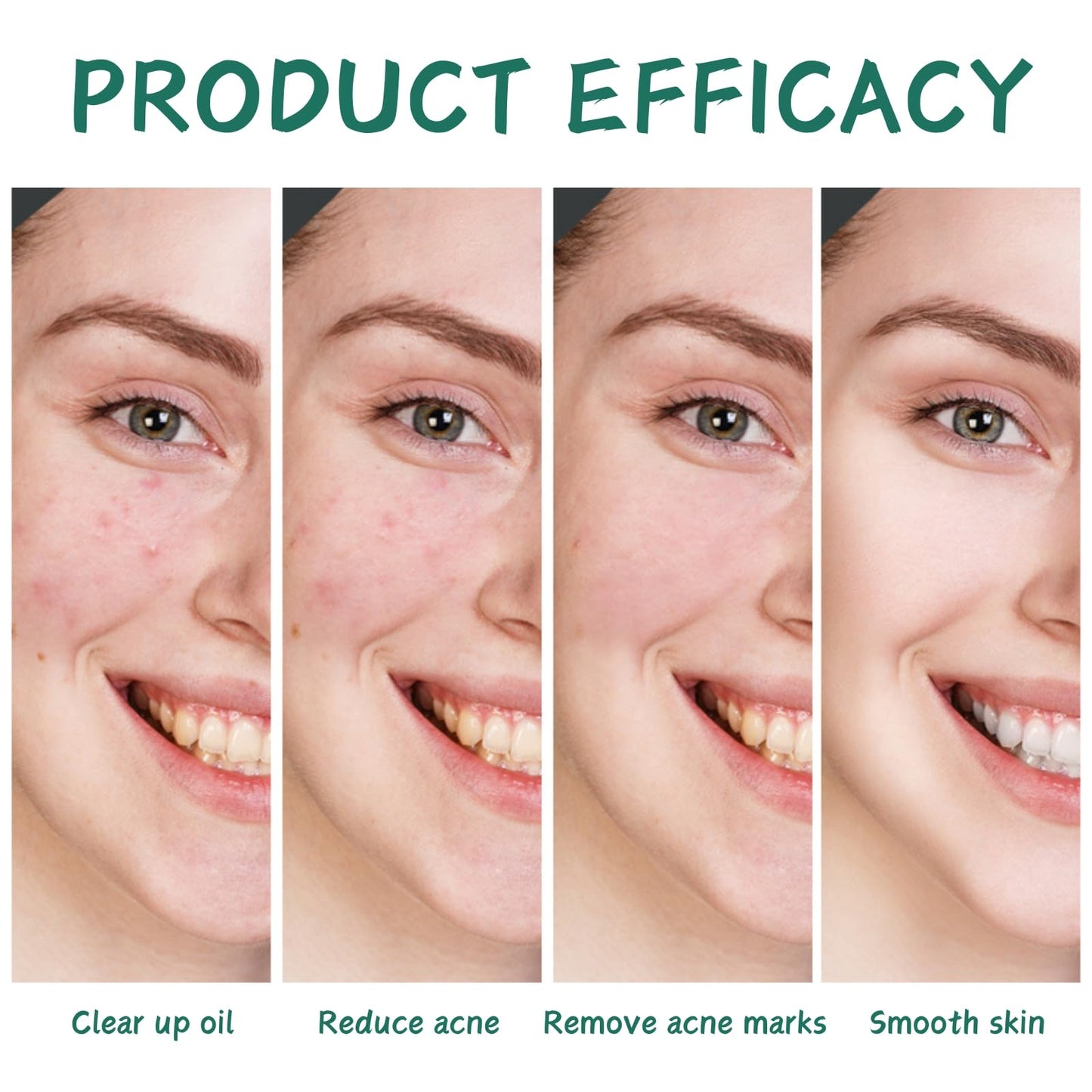 Acne Treatment Skin Care Kit - Salicylic Acid Skin Care Set - Acne Treatment for Face - Skin Care for Teens 10-12 - Salicylic Acid Serum,Clean Foam,Toner,Face Cream - Christmas Gifts Acne Kit