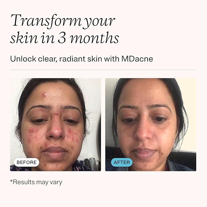 MDacne Salicylic Acid 2.0% (3-Pack) - Acne Treatment Cream, Facial Exfoliant Unclog Pores, Prevents Blemishes, Blackheads, Wrinkles & Fine Lines, Reduce Irritation for Sensitive Acne-Prone Skin