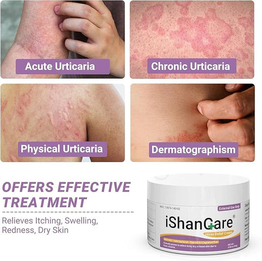 Urticaria Cream, Fast Acting Relief of Hives, Allergic Rashes, Itchy Skin, Redness, Swelling, Anti Fungal Hives Cream with All Natural Herbal Ingredients, 3.53 Oz