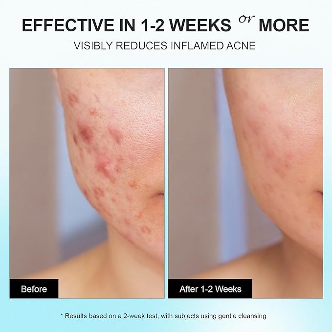 Acne Pimple Spot Treatment Cream: Cystic Hormonal Breakouts Control for Face & Back - 2% Salicylic Acid, Fast Redness Relief, Fades Blemishes & Post-Acne Marks, Teens-Adults, 1.8 oz