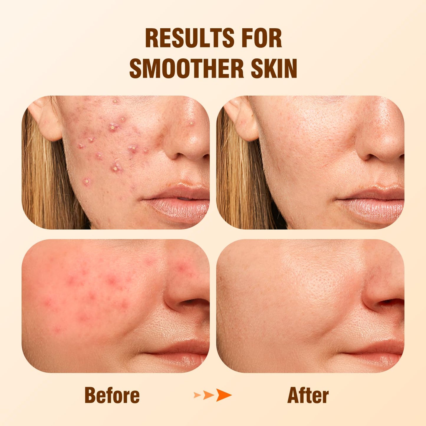 BIYSBER Salicylic Acid 2% Serum Solution for Face: Gently Exfoliating Facial Serum for Acne,Blackhead & Open Pores & Reduces Excess Oil - Hydrating& Soothing Skin Care Serum for Acne Prone&Oily Skin