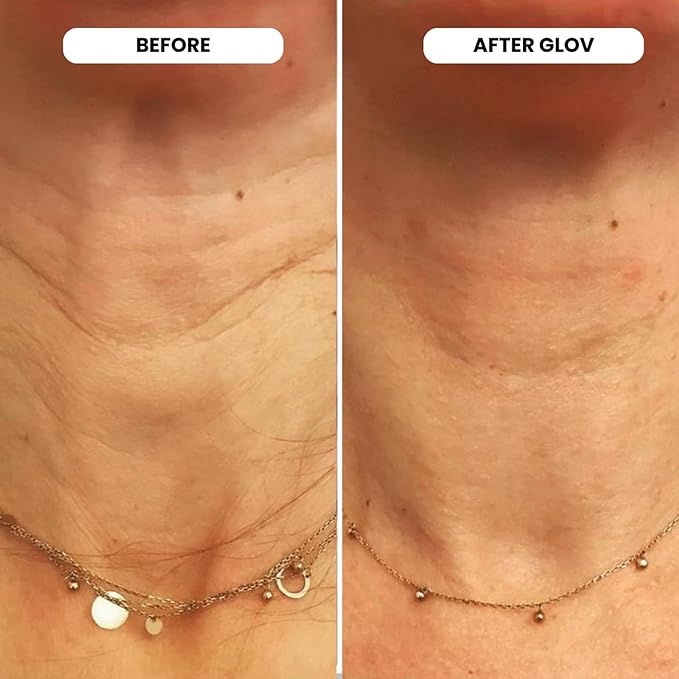 Micro Infusion System - 0.25mm 24k Gold Cosmetic Facial Stamp with Hyaluronic Acid & Peptide Serum Ampoules - At-Home Hydrating & Plumping Glow Kit for Face & Lips