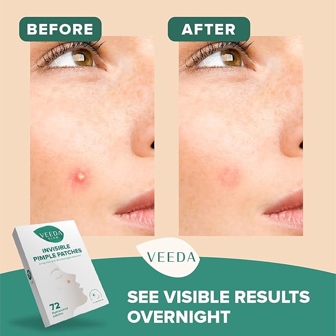 Veeda Glow Pimple Patches – Hydrocolloid Acne Stickers for Fast Healing, Invisible & Non-Irritating Zit Covers, Blemish Spot Treatment, 72 Count