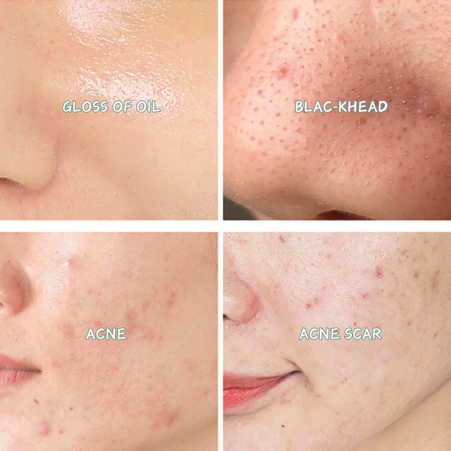 Acne Treatment Skin Care Kit - Salicylic Acid Skin Care Set - Acne Treatment for Face - Skin Care for Teens 10-12 - Salicylic Acid Serum,Clean Foam,Toner,Face Cream - Christmas Gifts Acne Kit