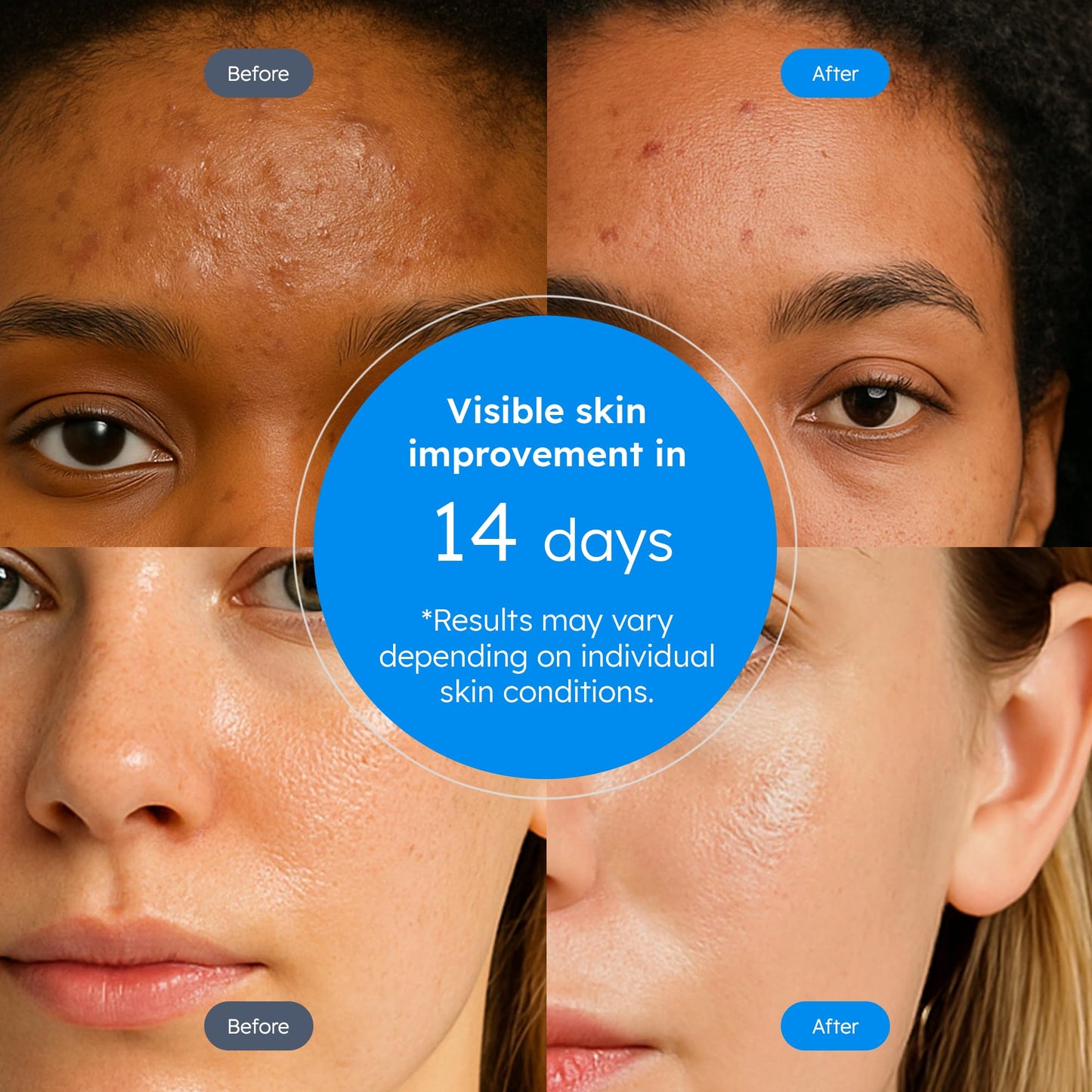 Blissberry Acne Serum 0.1% Salicylic Acid – Gentle Calming Serum for Oily & Acne-Prone Skin, Clears Blackheads & Whiteheads, Reduces Oil & Redness – Hydrating BHA Face Treatment, 0.5 Fl Oz