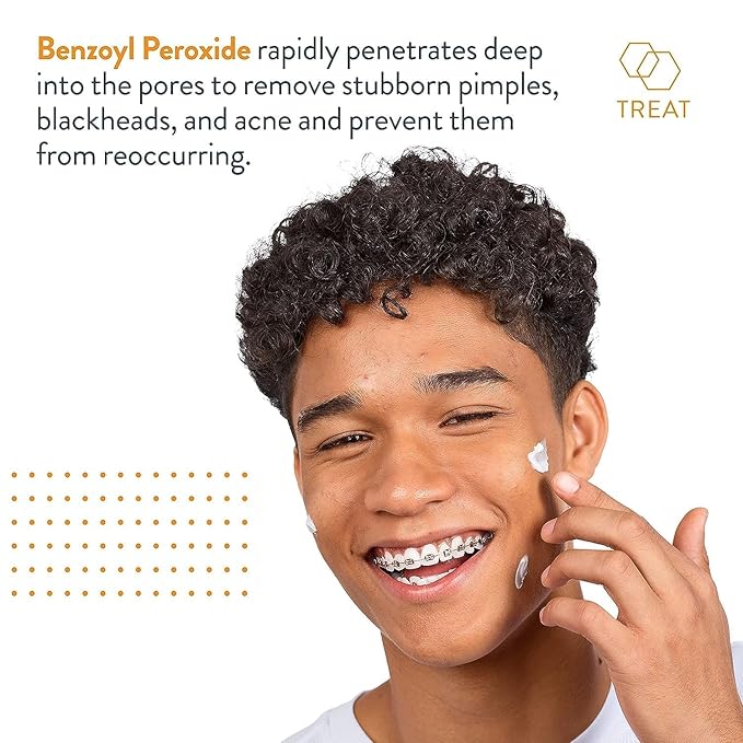 Acne Free Terminator 10 Acne Spot Treatment With Benzoyl Peroxide 10% Maximum Strength Acne Cream Treatment, 1 Ounce, Pack of 3